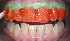 blanqueamiento dental laser o de dientes
